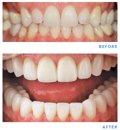Sam Cress Before and After smile RGB