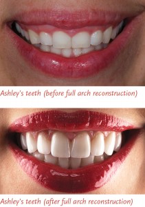 Ashley's before and after smile